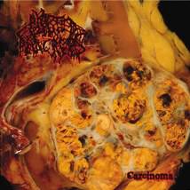 Blasted Pancreas : Carcinoma